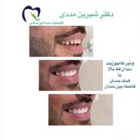 کامپوزیت ونیر توسط دکتر شیرین مددی