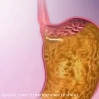 رفلاکس معده