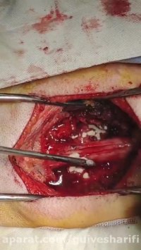 193. جراحی تومور شوانوم گردن در دختر جوان توسط دکتر گیو شریفی