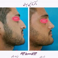 جراح بینی در مشهد | گرفتن مشاوره 09380000893