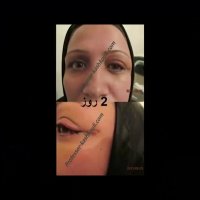 فیلم جراحی تومور حدقه | پروفسور کشکولی | جراح پلک تهران