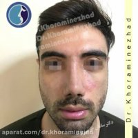 رینوپلاستی