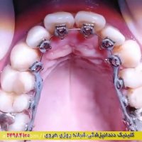 ارتودنسی لینگوال چیست و چگونه دندانها با ارتودنسی لینگوال مرتب می شوند؟