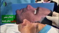 جراحی ترمیم بینی با غضروف دنده | دکتر باستانی نژاد | جراح بینی