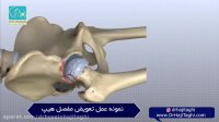 فیلم عمل تعویض مفصل هیپ