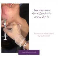 درمان جای جوش با سابسیژن