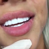 اصلاح طرح لبخند -دکترمجیدقیاسی دندانپزشک زیبایی مشهد