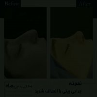 جراحی بینی استخوانی با قوز سراسری