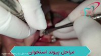 کشیدن و ایمپلنت همزمان دندان