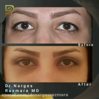 جراحی همزمان پلک و بینی