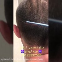 اسکالپ تخصصی روشی نوین برای رفع کم پشتی موهای سر