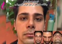 فیلم نتیجه جراحی بینی بلافاصله بعد از باز کردن گچ بینی