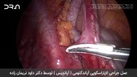 فیلم عمل جراحی لاپاراسکوپی آپاندیس - آپاندکتومی توسط دکتر داود نریمان زاده
