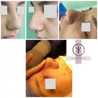 فیلم جراحی نوک بینی