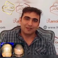 کاشت مو رنسانس - کلینیک تخصصی رنسانس