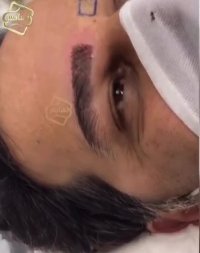 کاشت ابرو -کلینیک تخصصی رنسانس