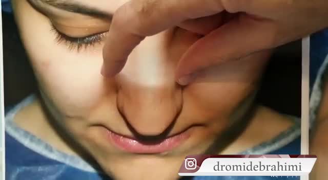 بینی نیمه فانتزی | دکتر ابراهیمی
