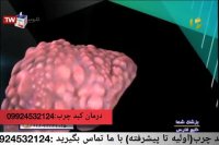 درمان قطعی کبد چرب