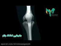 فیلمی کوتاه از جا بجایی کشکک زانو