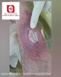 آموزش درمان زخم سوختگی با سلولیت وسیع