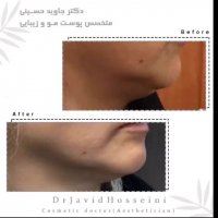 فیلم بهبود قابل ملاحظه غبغب با هایفوتراپی