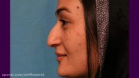 فیلم واقعی جراحی بینی استخوانی بعد از 4 ماه