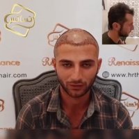 کاشت مو رنسانس - کلینیک تخصصی رنسانس