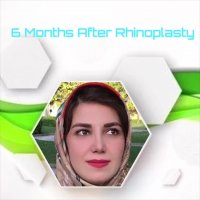 6 ماه بعد از جراحی بینی توسط دکتر شهریار یحیوی