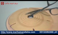آموزش تعویض کیسه یک تکه و دو تکه استوما(استومی)