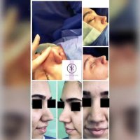 فیلم جراحی زیبایی بینی