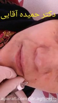 تزریق ژل خط خنده