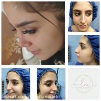 عمل زیبایی بینی بعد از یکسال