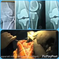 جراحی تعویض کامل مفصل زانو توسط دکتر جواهری