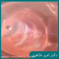 انیمیشن کولونوسکوپی