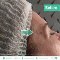 قبل و بعد تزریق ژل به شقیقه