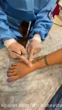 فیلم پاک کردن تتو با لیزر کیوسویچ