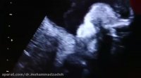 سونوگرافی صورت جنین 28 هفته و بررسی لب شکری