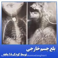بلع جسم خارجی توسط کودک 18 ماهه