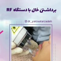 برداشتن خال با لیزر آر اف