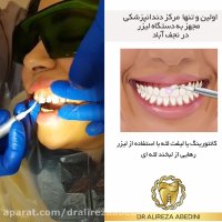 لیفت لثه با لیزر