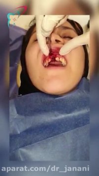 ایمپلنت دندان