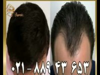 کاشت مو به روش SUT مرکز مو رنسانس