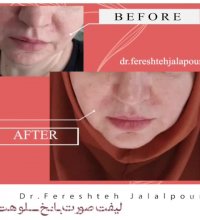 لیفت صورت با نخ سلوهت