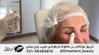 تزریق بوتاکس مصپورت روی خطوط بینی