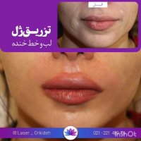 تزریق ژل لب و خط خنده در کلینیک ارکیده