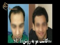 کاشت مو به روش SUT مرکز مو رنسانس