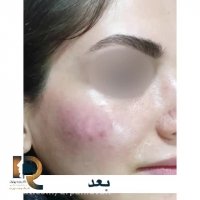 تزریق فیلر به گونه