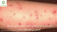 درمان های خانگی گزیدگی ساس