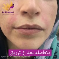 فیلم تغییر جالب خط خنده بعد از تزریق ژل