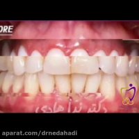 لمینت دندان